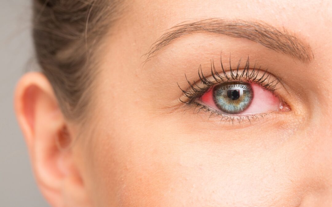 What Causes Red Eyes? Common Causes and Treatments