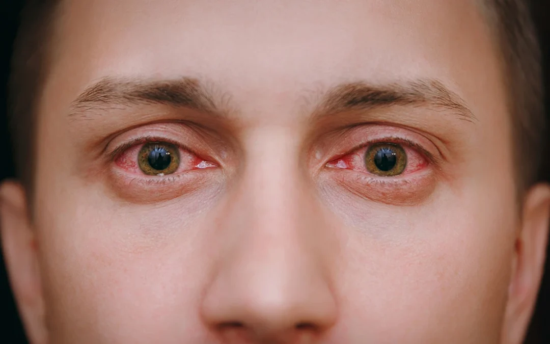 Pink Eye: Symptoms, Causes & Treatment